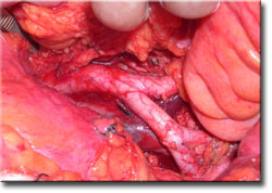 Jinekoloji kadn hastalklar pap smear kolposkopi jinekolojik onkoloji kanser jinekolojik kanserler onkoloji jinekolog Tugan Bee tamoksifen kistik kalnlama